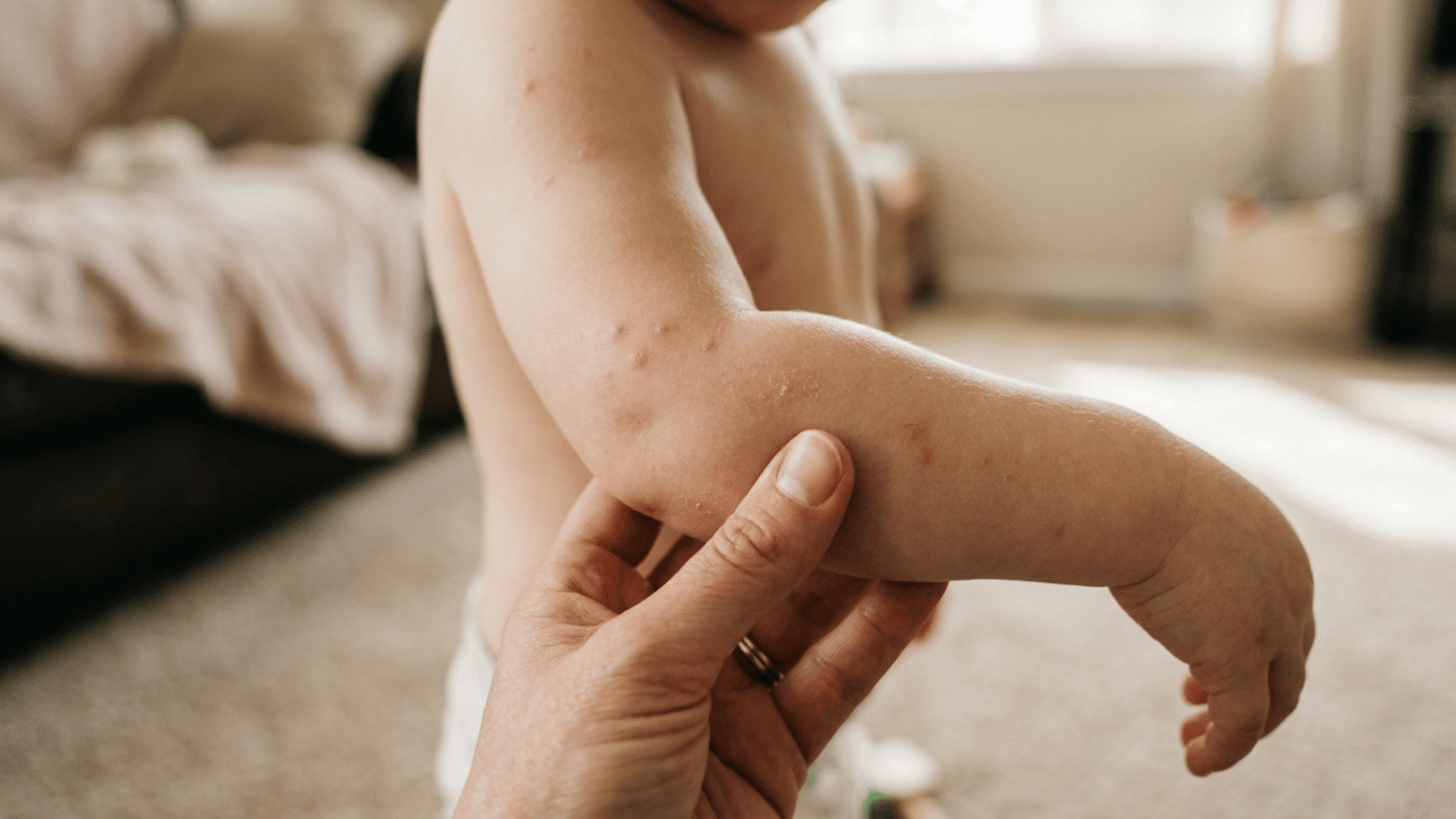 parent checking toddler's arm for common bumps on toddler skin