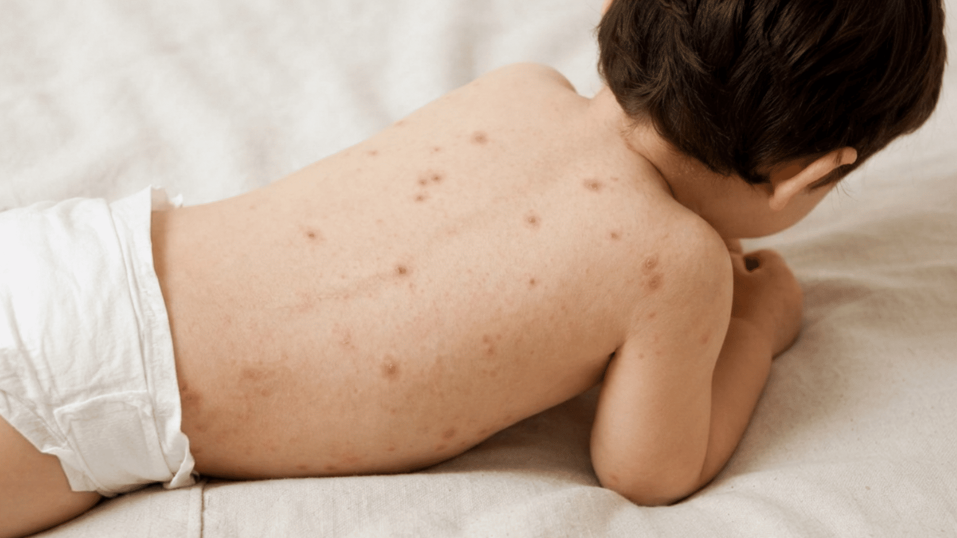 toddler-skin-bumps